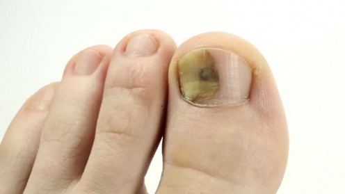 The Best Treatment for Toenail Fungus That Will Not Cost an Arm and a Leg The Best Treatment for Toenail Fungus That Will Not Cost an Arm and a Leg