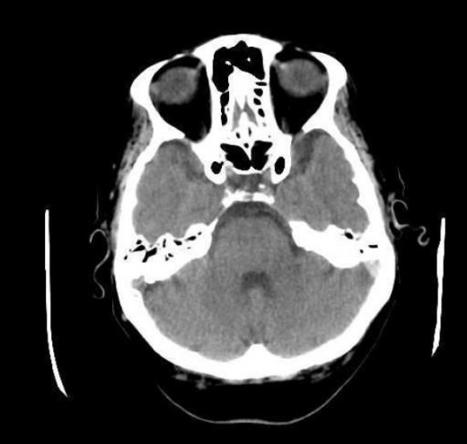 MRI Scan of brain