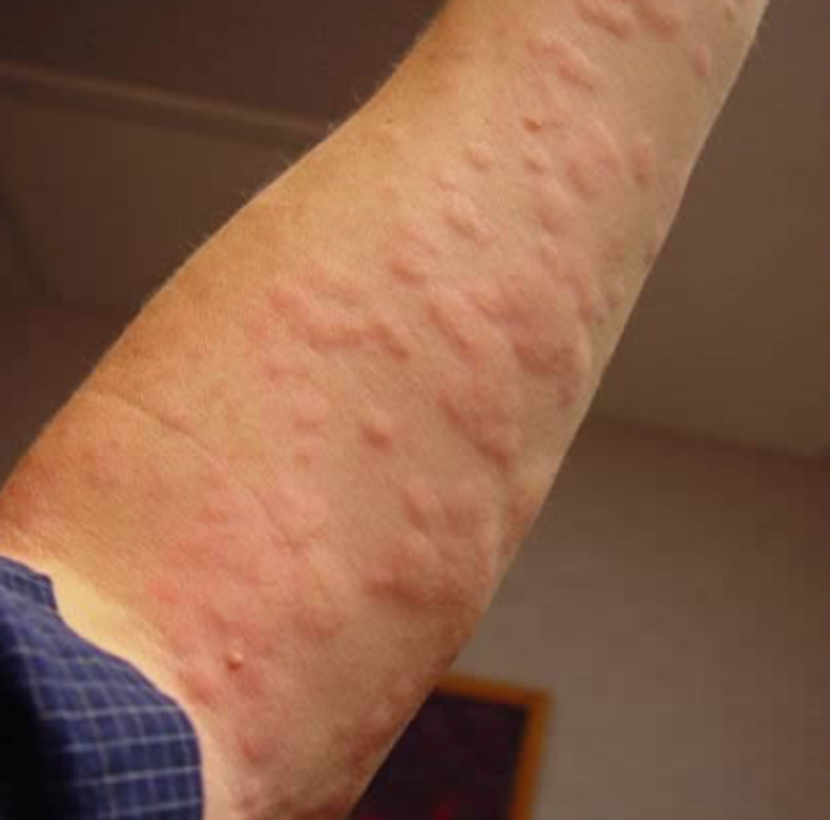 Relief From Hives (Urticaria) and Eczema Rashes In Under One Minute