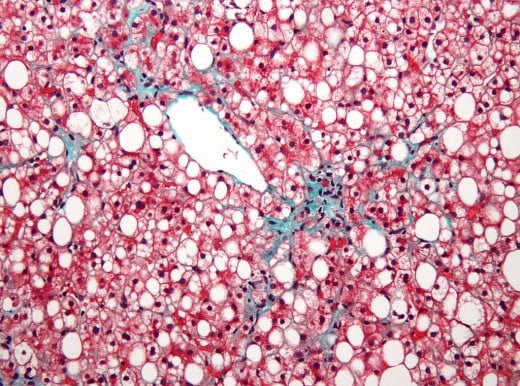 Small white structures represents fat in the liver cells