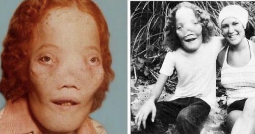 Two images of the real-life Rocky Dennis, later played by Eric Stoltz in the film “Mask.”