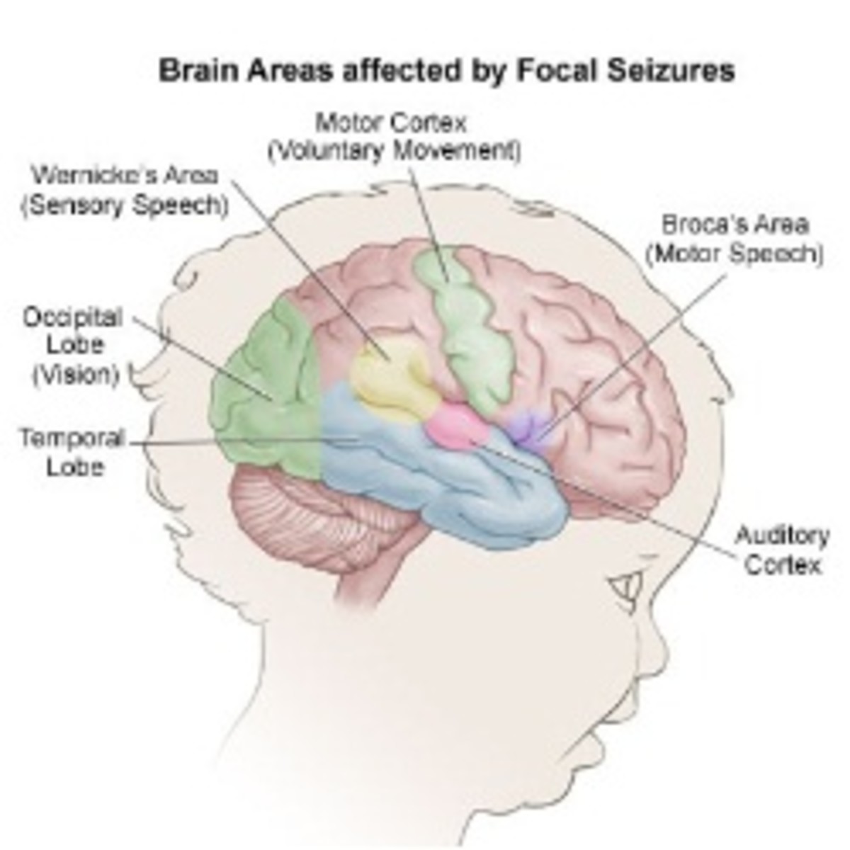 Areas affected by Ohtahara Syndrome