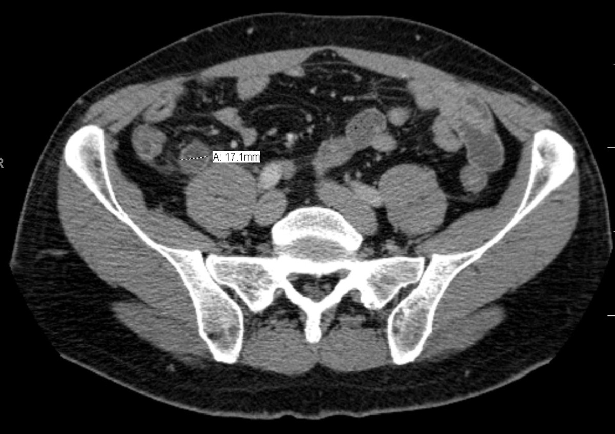 This CAT scan shows a case of appendicitis. Note that the diameter of the appendix is swelled up to 17 mm in diameter. The normal size is around seven or eight mm.