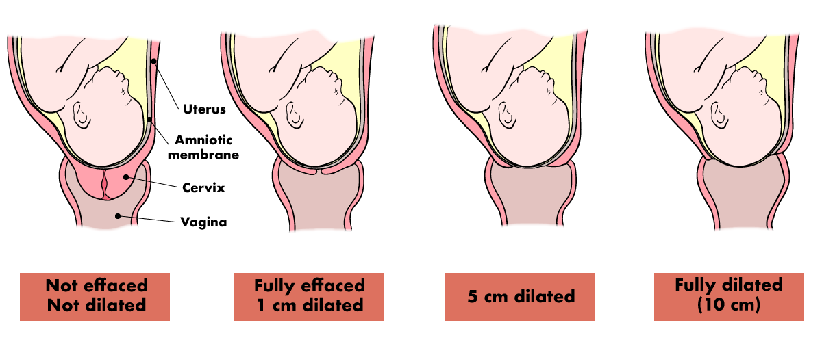 Effacement And Dilation Of The Cervix Chart