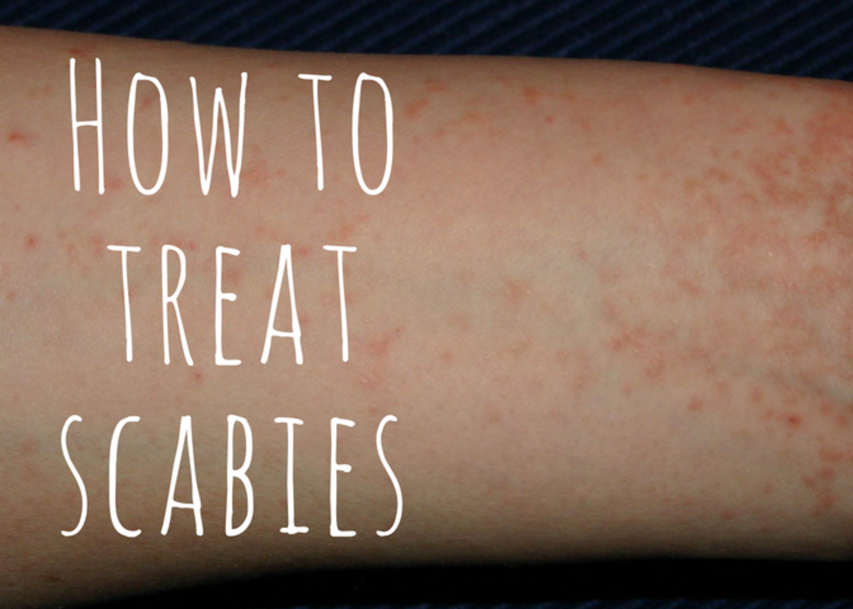 Top Over The Counter Scabies Treatments Prescription Medications