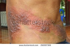 Shingles or Herpes Zoster - Why They Affect Mostly the Elderly