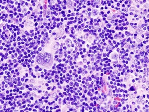 Mixed Cell Type, one of the four forms of Hodgkin's Lymphoma