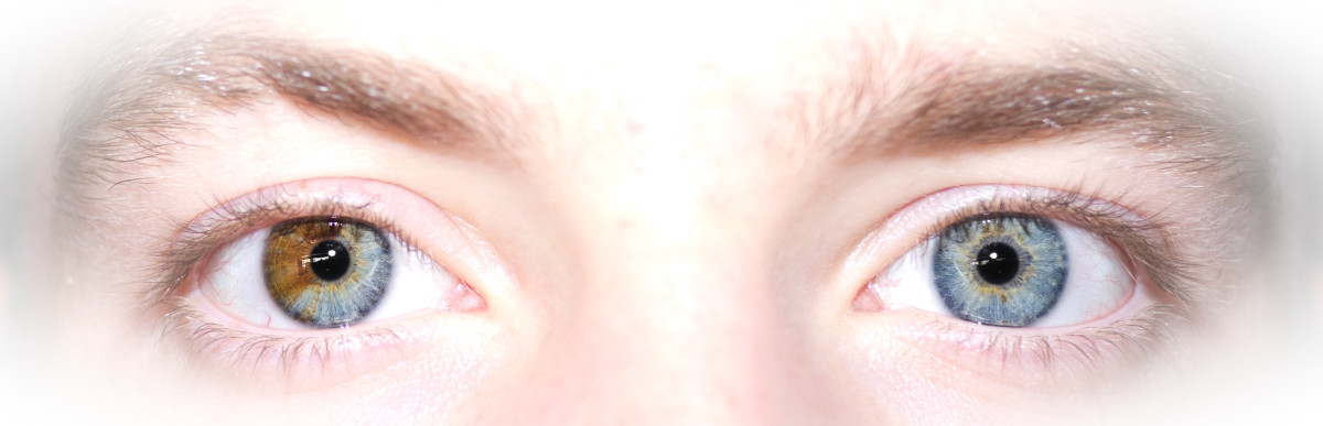 This photo shows heterochromia when one eye is partially a different color, rather than the entire iris being a different color.