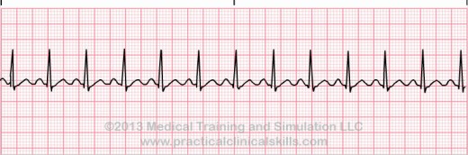 wave seen on sinus tachycardia patient