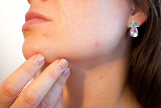 3 effective natural remedies for acne