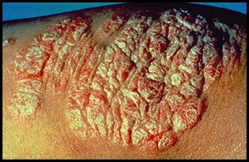 Advanced Plaque Psoriasis