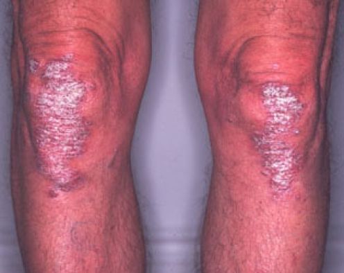 Plaque Psoriasis Knees