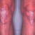 Plaque Psoriasis Knees Plaque Psoriasis Knees