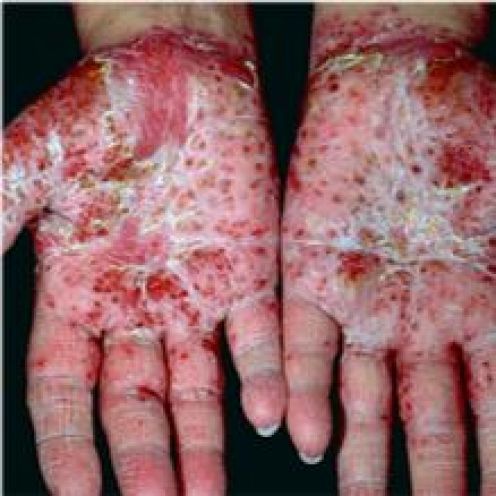 Psoriasis Hands