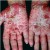 Psoriasis Hands Psoriasis Hands