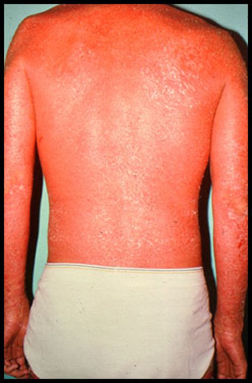 Erythrodermic Psorisis