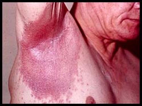 Inverse Psoriasis