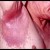 Inverse Psoriasis Inverse Psoriasis