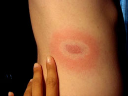 bullseye rash from stoplyme.com