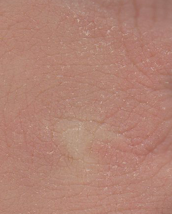 A closeup of chapped skin.