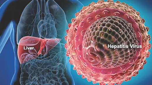 Pic: Viral hepatits