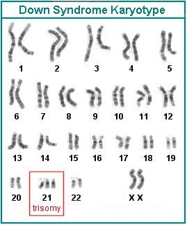 Pic: Down Syndrome of Trisomy 21 karyotype