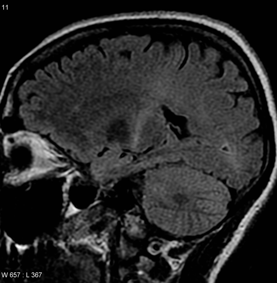 MRI with increased signal in the posterior part of the internal capsule that can be tracked to the motor cortex, consistent with the diagnosis of ALS 