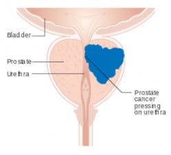 Key Information About Prostate Cancer