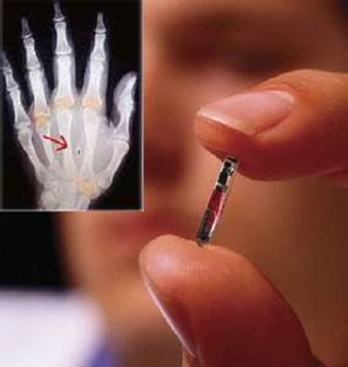 RFID Chip inserted in hand