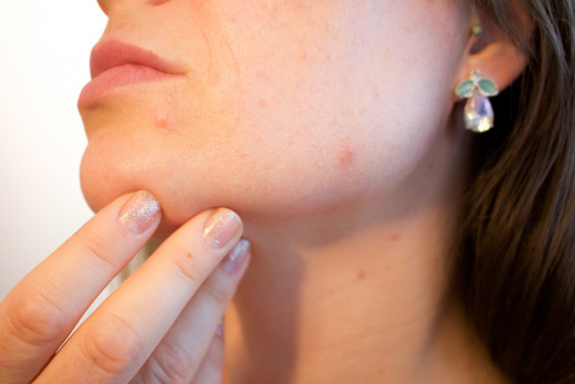 Acne anywhere on the body is an annoyance but back acne can be particularly irritating. 