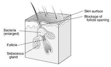 Blocked Skin Pore