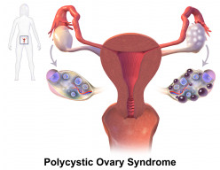 Best Known PCOS Diagnosis and Treatment Options