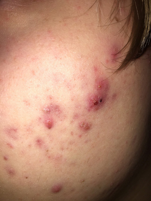 Active acne along with scars
