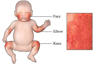 What does baby eczema look like?