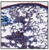 From paper "Toxicology of Graphene-Based Nanomaterials," mouse lung, graphene "induces patchy fibrosis."