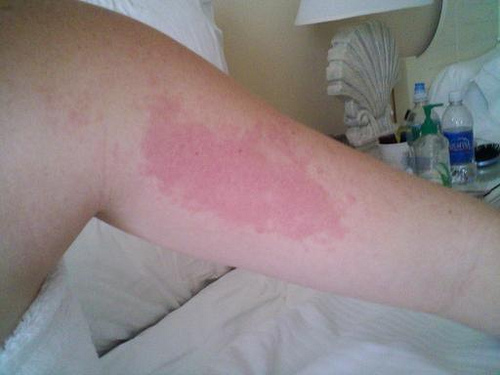Typical allergic rash on skin