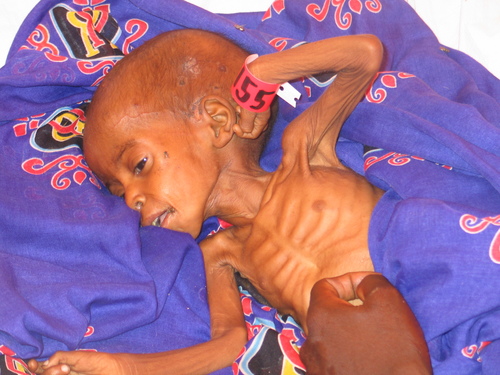 Child suffering from starvation in Darfur