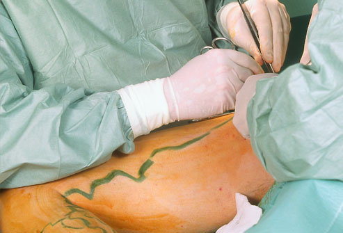Varicose veins stripping and ligation