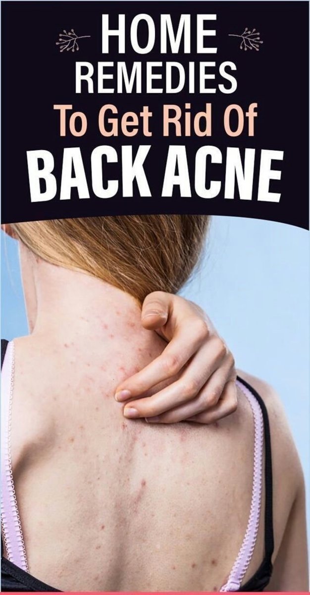 Home Remedies To Get Rid of Back Acne