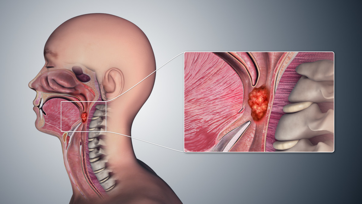 Symptoms of Oropharyngeal Cancer