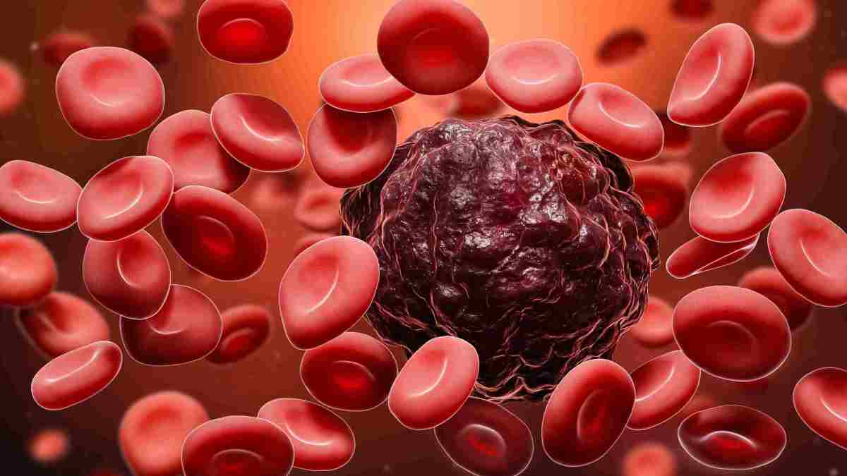 3 Types of Blood Cancer