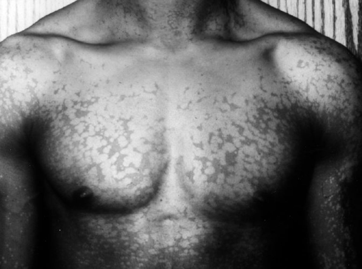 Tinea versicolor on a man's chest.