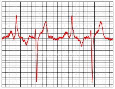 ECG Pattern of the Heart. Photo from:http://www.topnews.in/healthcare/sites/default/files/ECG_0.jpg