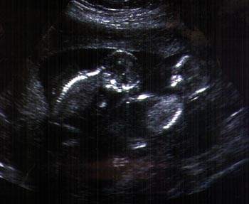 Ultrasound of twins at approximately 14 weeks gestation