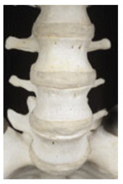 Orthopedic Disk Fusion - Allow Fusion on your spine or not