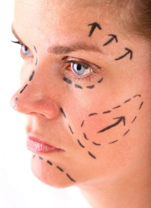 Some common incision sites for face lifting surgery.