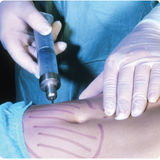 Plastic surgeon preparing and marking the patient's skin before starting liposuction.