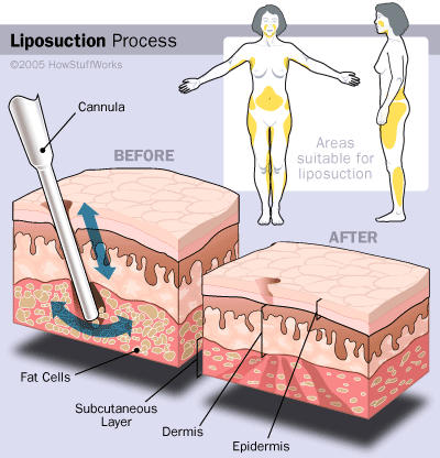 How liposuction is done?