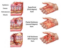 Cosmetic Surgery – An illustrated guide to treatment of burns