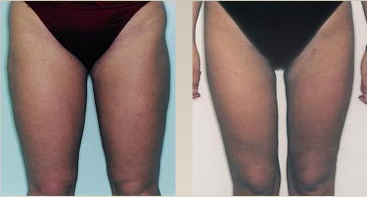 Leg/thigh liposuction surgery [atcosmetics.com]